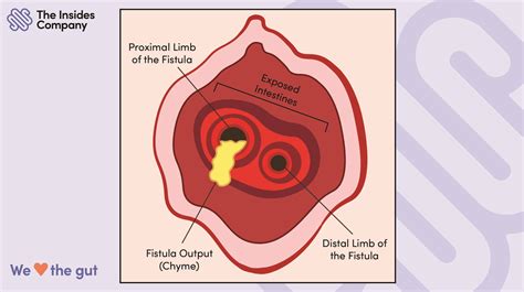 fistulae